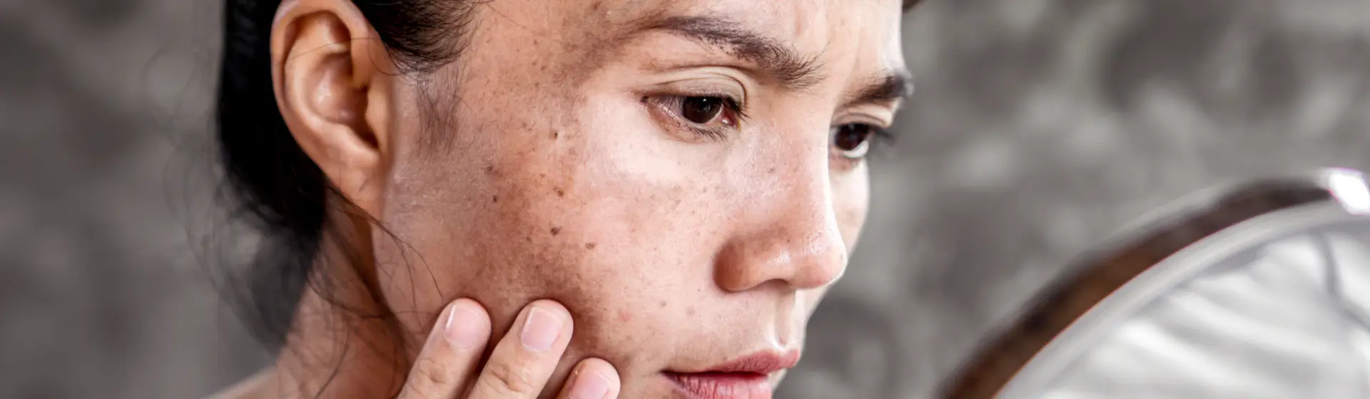 Melasma no rosto: veja 7 produtos que podem amenizar as manchas