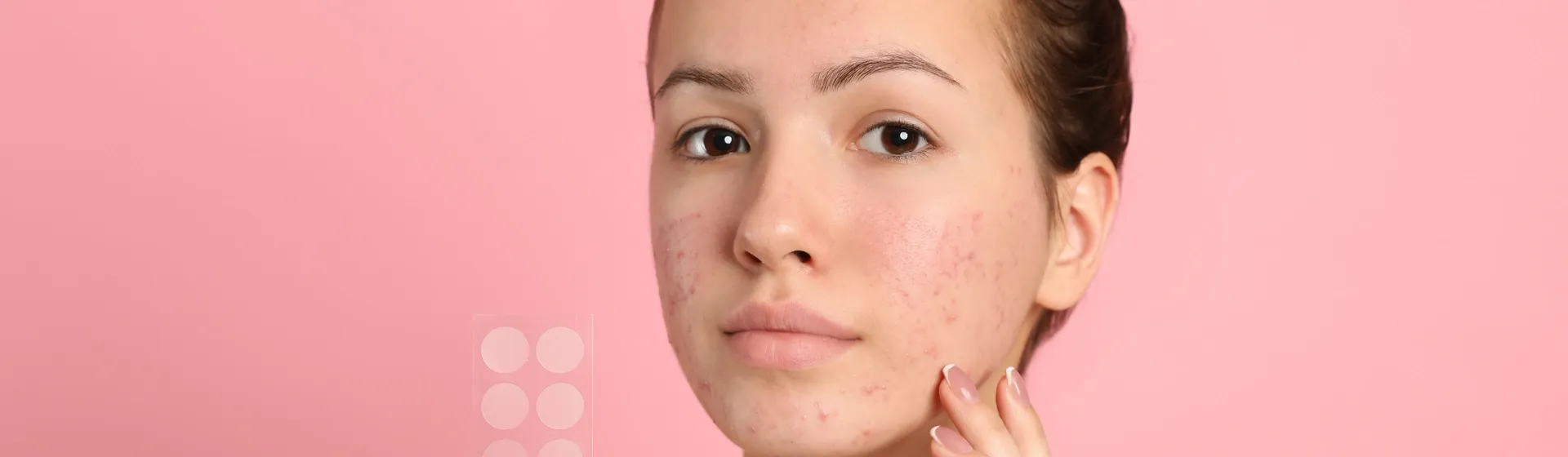 Mulher tocando em cicatrizes de acne em seu rosto