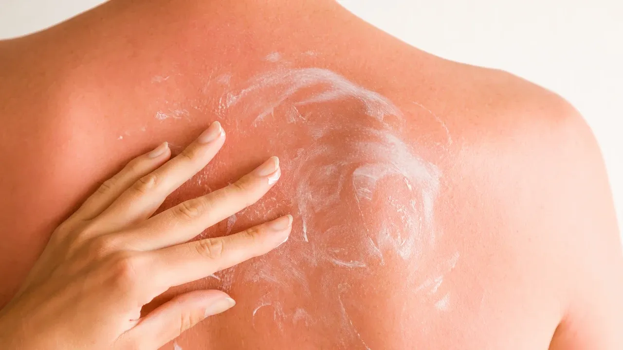Pessoa passando creme pós-sol em costas de pessoa com a pele queimada