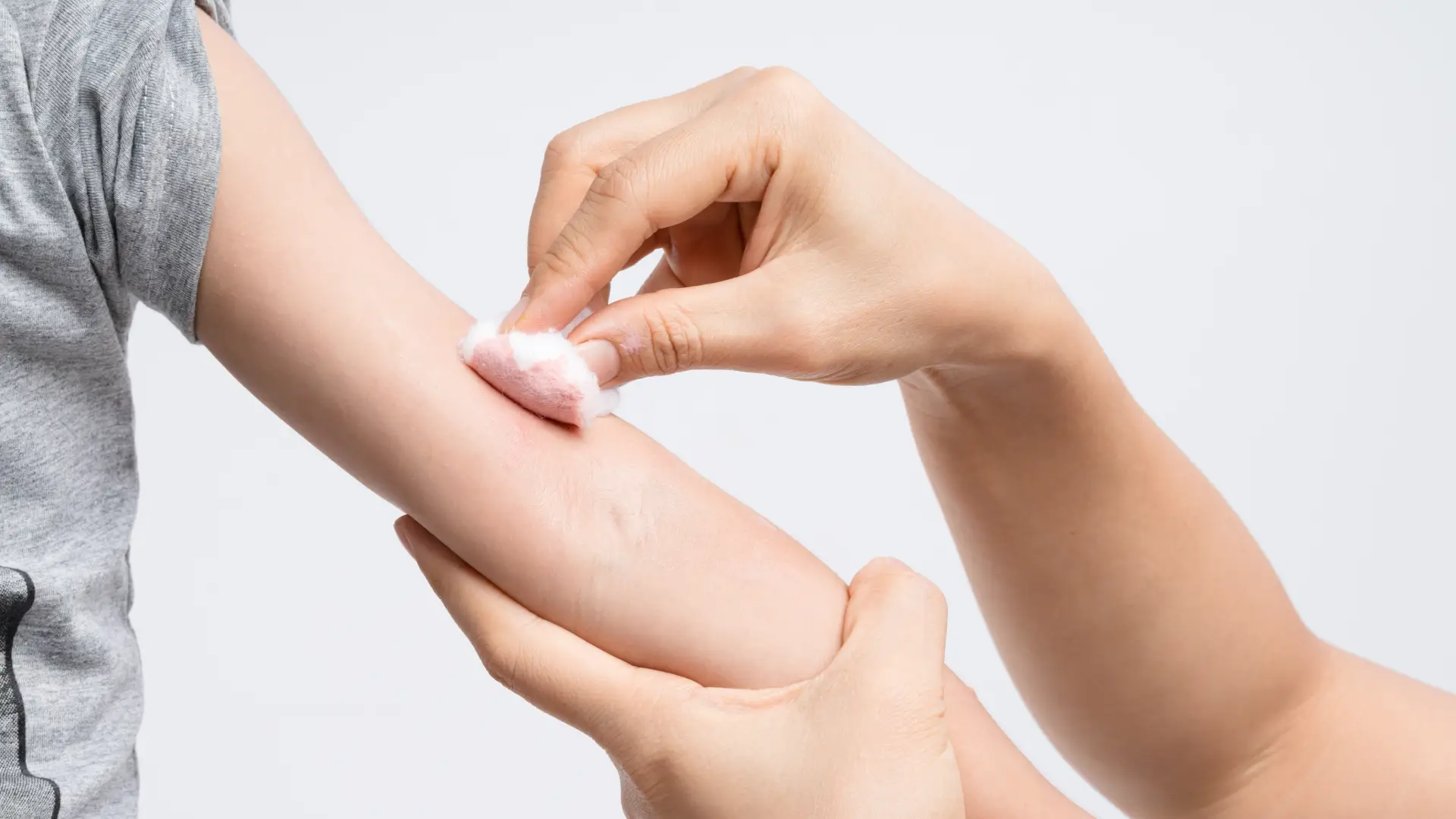 Mãe segurando algodão à pele com medicamento para curar ferida no braço do filho. 