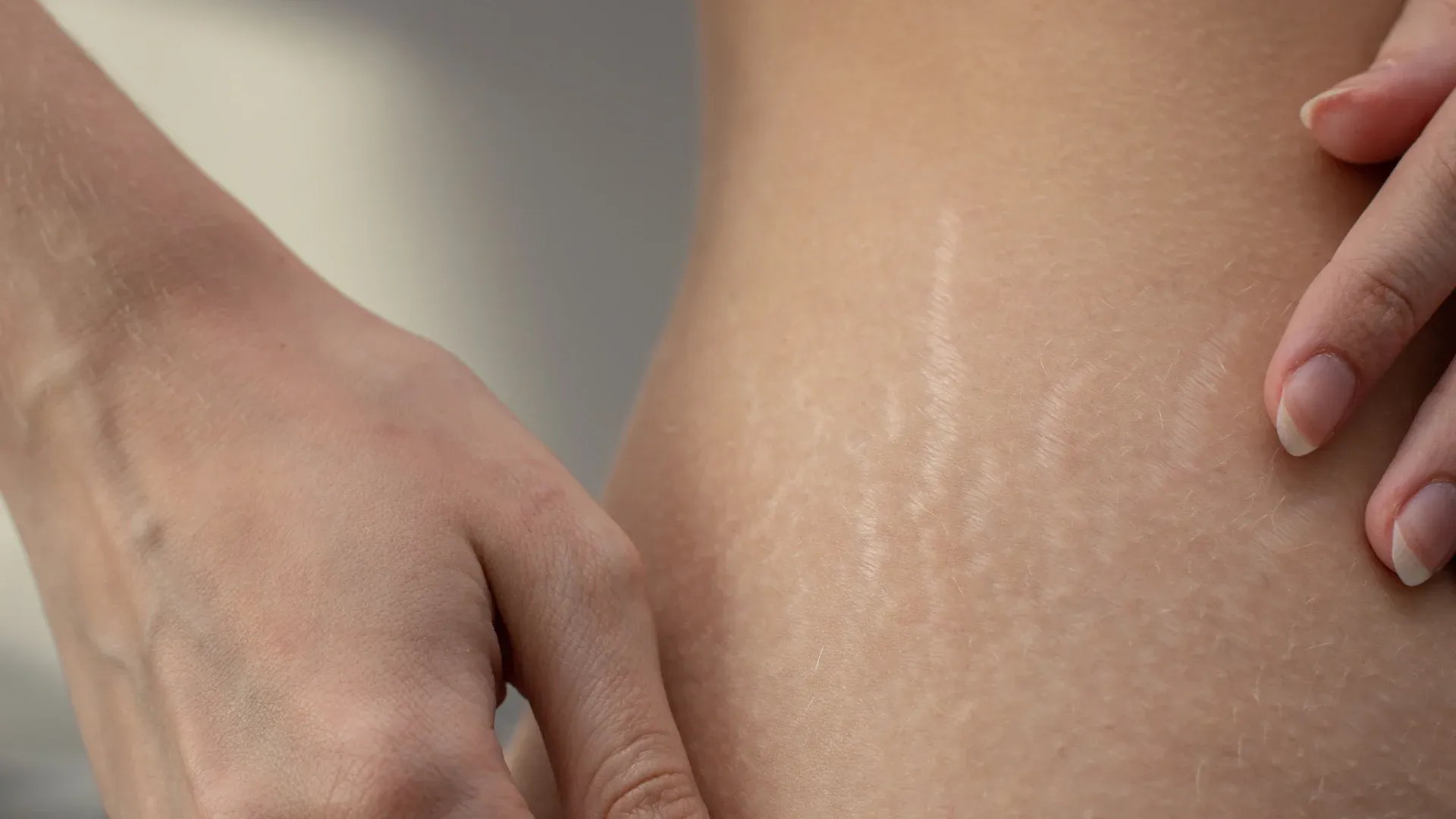 Buscapé em estrias na lateral da barriga 